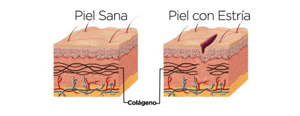 Piel sana y piel estría