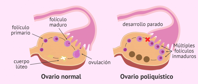 Ovario normal y poliquístico