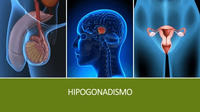 ¿Cuál es la relación entre el zinc y la testosterona? 3 Representación gráfica de hipogonadismo