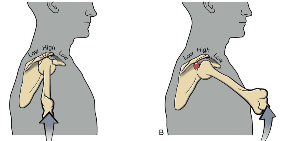 Músculos implicados en press militar con mancuernas (activación muscular) 5 Flexión del hombro