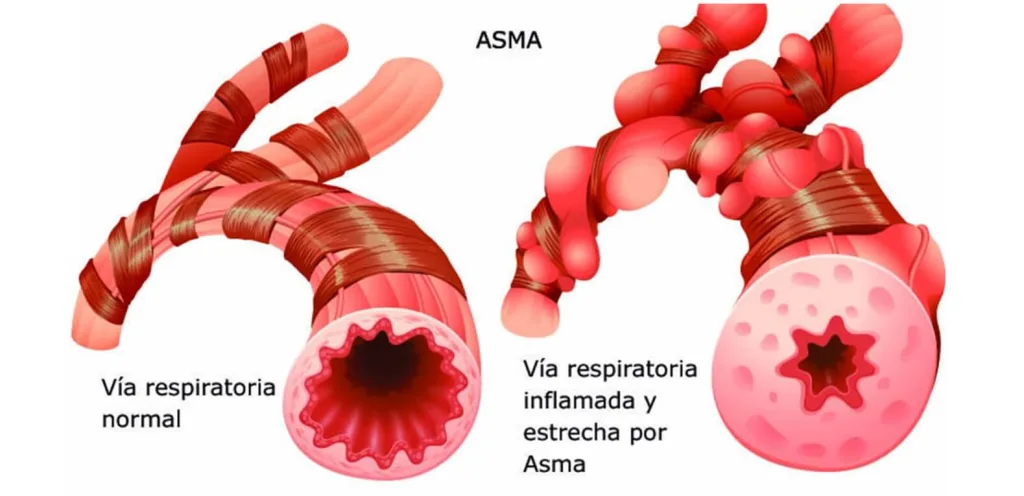 qué es el asma