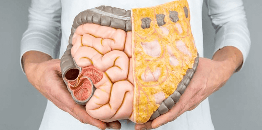 Intestino sin y con grasa visceral 