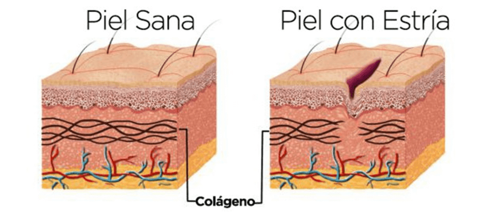 Estrías por aumento de masa muscular: por qué suceden y cómo evitarlas 3 Piel sana y piel con estría