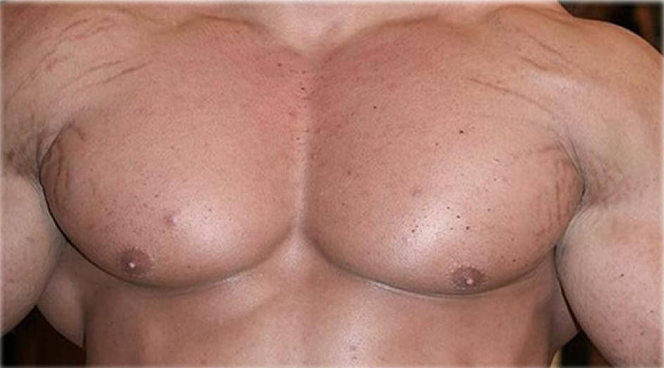 Estrías por aumento de masa muscular: por qué suceden y cómo evitarlas 5 Uso de asteroides aparición de estrías