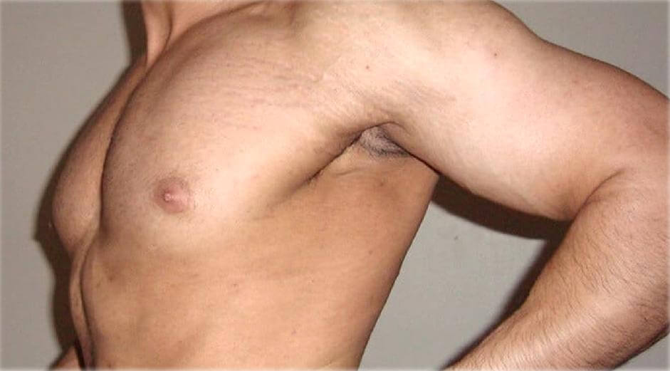 Estrías por aumento de masa muscular: por qué suceden y cómo evitarlas 7 Aparición de estrías en zonas del cuerpo