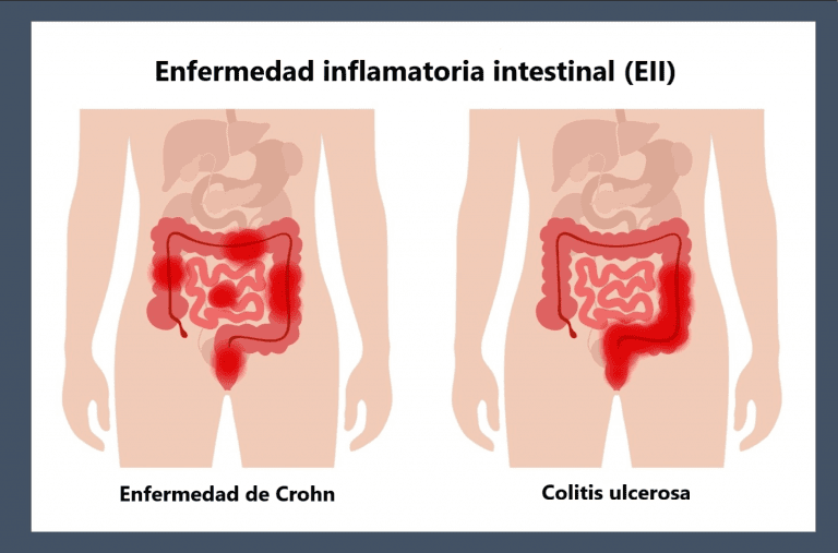 Enfermedad inflamatoria intestinal