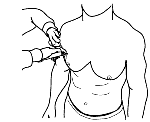 Pliegue diagonal pecho