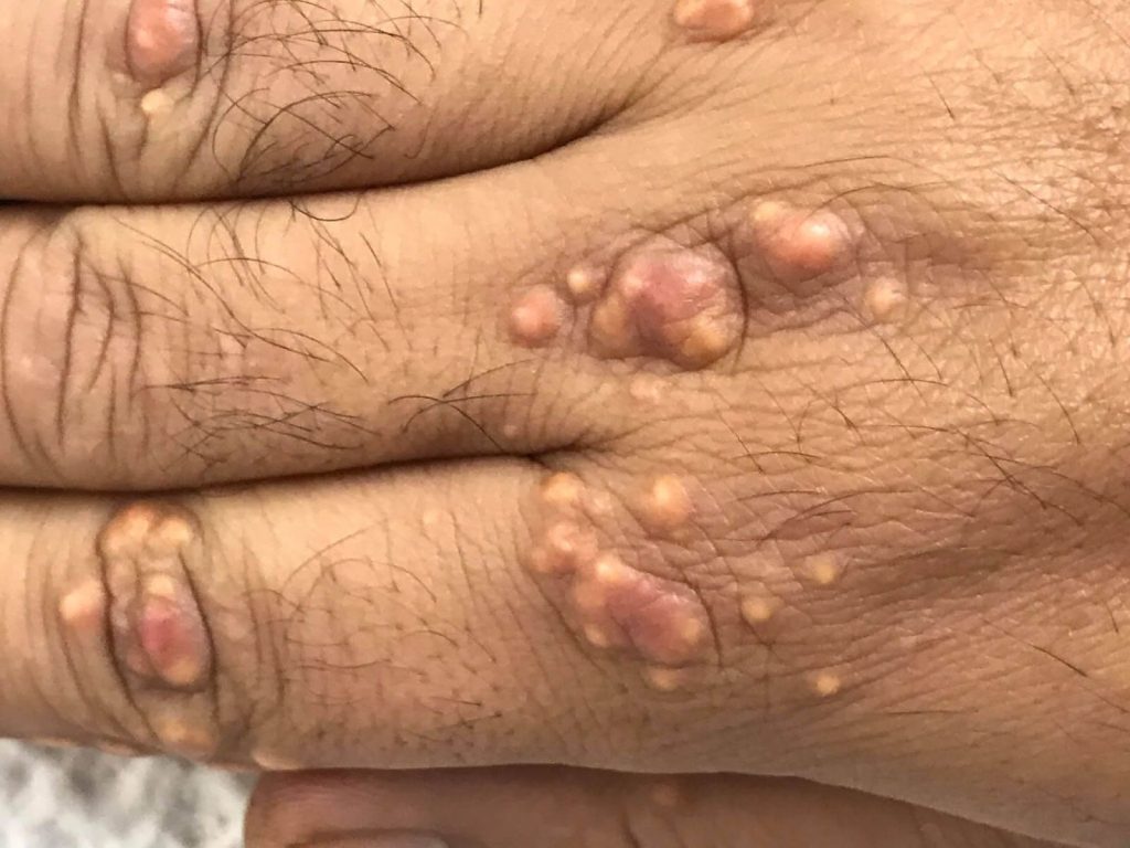 Síntomas de hipercolesterolemia