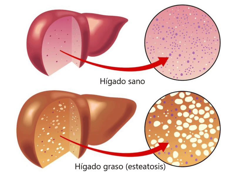 Patologías asociadas glucosa y fructosa