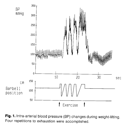 Cambios en la presión arterial intraarterial 