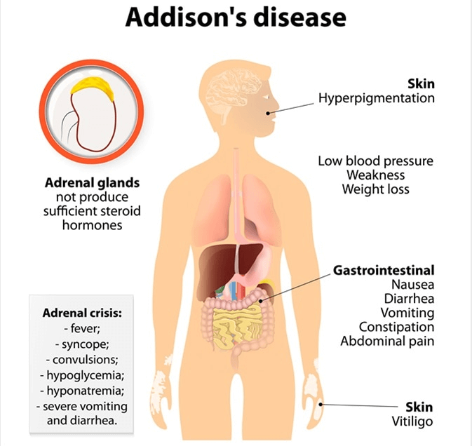 Enfermedad de Addison