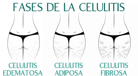 Fase de la celulitis