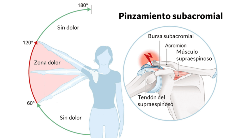 Dolor y fisiopatología pinzamiento subacromial