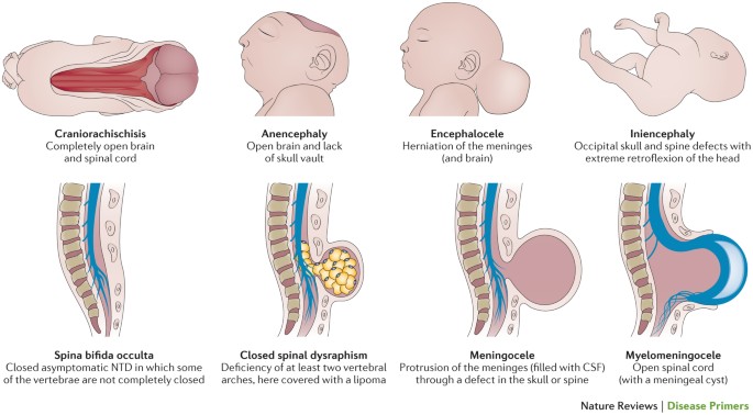 Problemas en cerebro y médula espinal 