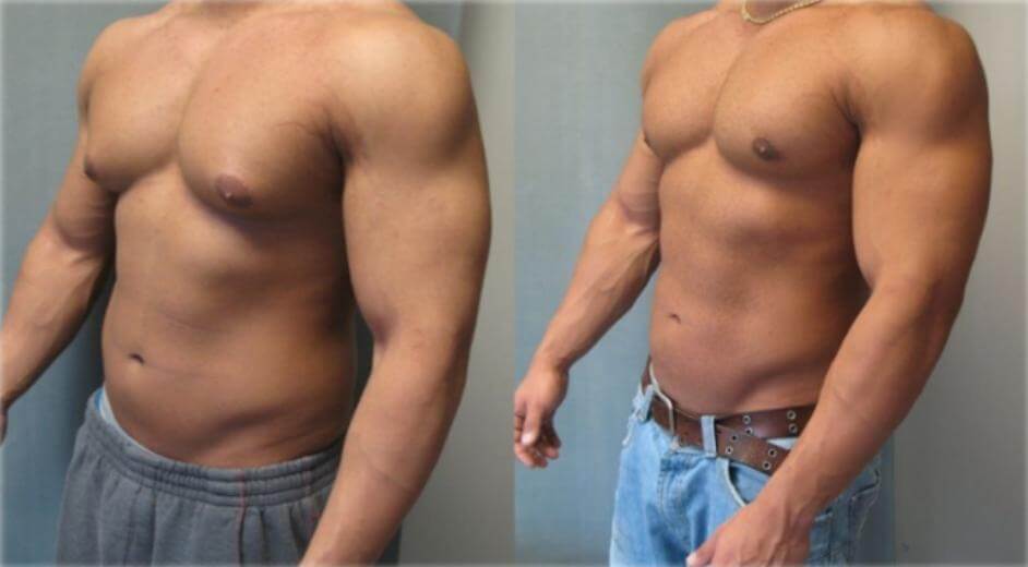 ¿Cómo saber si alguien toma esteroides? 7 señales reales 29 Diferencias uso de esteroides hombres