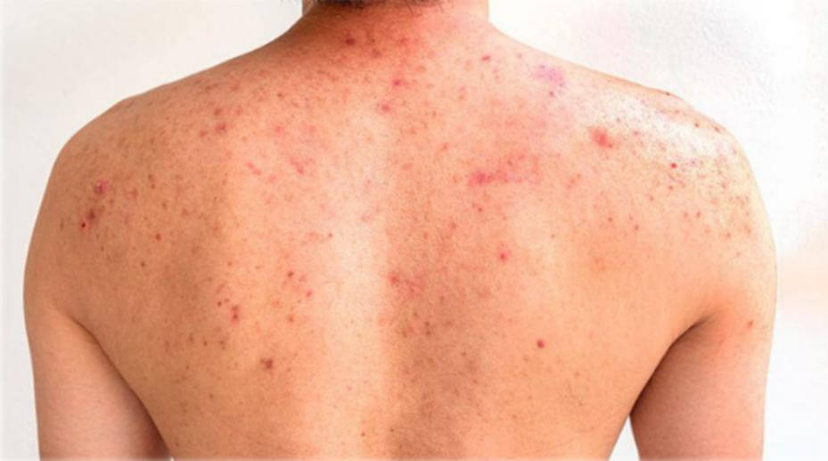 ¿Cómo saber si alguien toma esteroides? 7 señales reales 31 Poros y desarrollo de acné