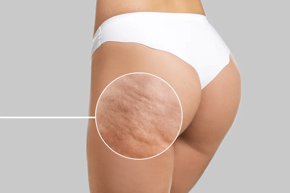 Suplementos para la celulitis