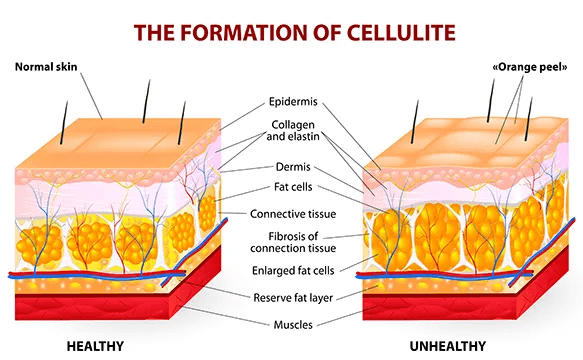 Esquema formación de la celulitis