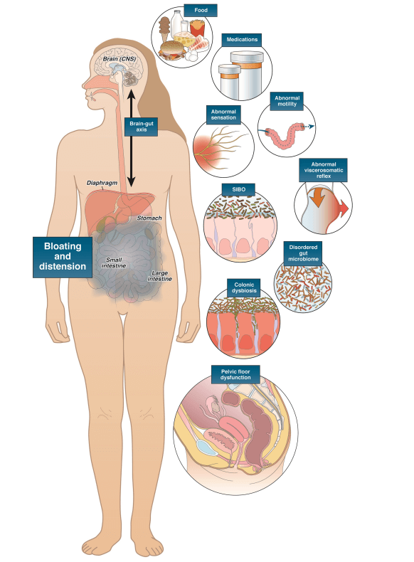 Cómo eliminar la hinchazón abdominal (causas y soluciones) 2 Hinchazón y la distensión abdominal