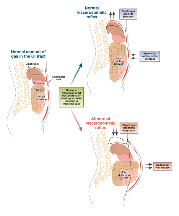 Cómo eliminar la hinchazón abdominal (causas y soluciones) 6 hinchazon abdominal 3