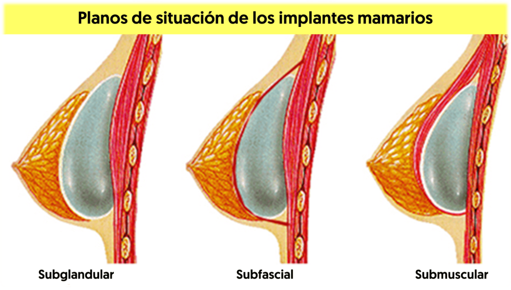 ¿Entrenar pecho disminuye los senos? 29 Mujeres con implante mamario