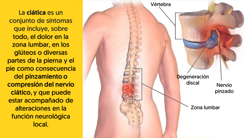 Representación ciática y causas