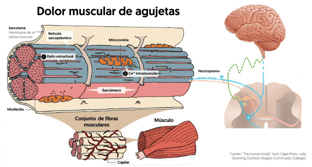 Dolor muscular de agujetas